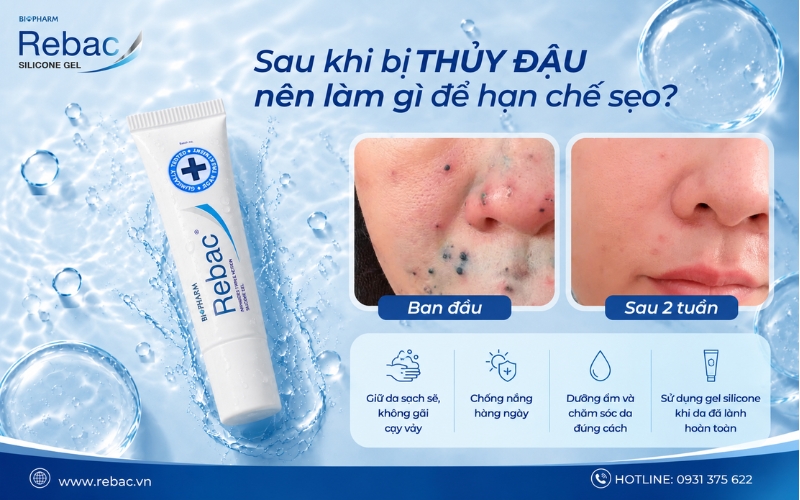 sau khi bị thủy đạu nên chăm da như thế nào